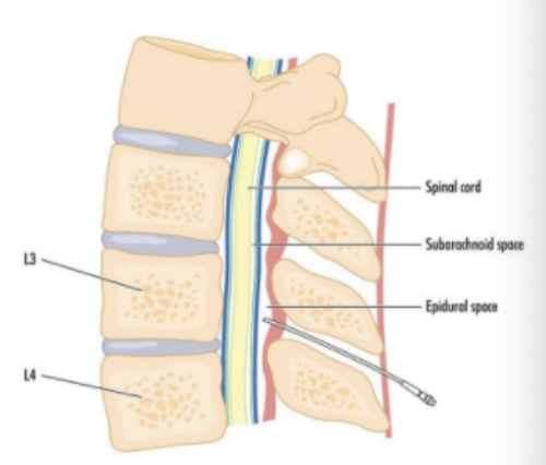 <p>local anesthetic directly into spinal fluid in subarachnoid space</p><ul><li><p>typically with C/S </p></li></ul>