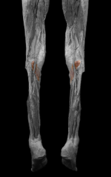 <p>origin: lateral condyle of femur </p><p></p><p>insertion: proximal tibia </p><p></p><p>action: flex leg at knee, medially rotate tibia </p><p></p><p>innervation: tibial nerve </p>