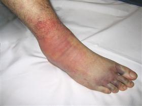 <p>Cast is placed before inflammation has stopped</p><ul><li><p>Compresses blood vessels (low BF)</p></li><li><p>May lead to Necrosis</p></li><li><p>S/S: severe pain beyond initial injury</p></li><li><p>Tx: Remove cast, Fasciotomy to cut surrounding tissue (last resort)</p></li></ul><p></p>