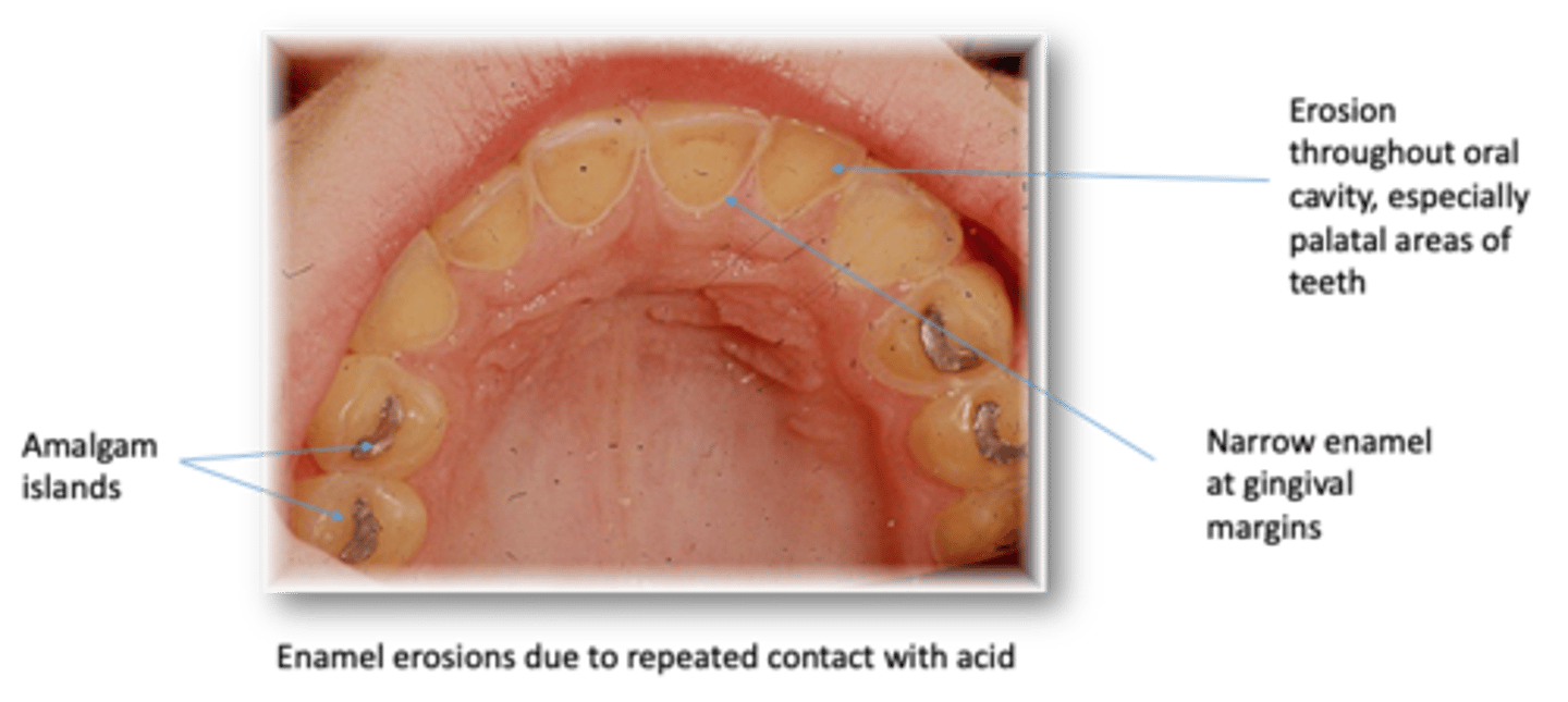 <p>Serious mental health disorder characterized by episodes of binge eating &amp; then purging. Binge-purge cycles cause physical health problems such as electrolyte imbalances &amp; erosion of tooth enamel</p>