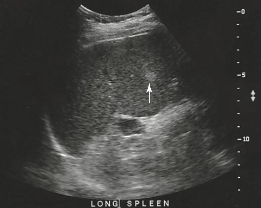 <p>a 30 year old patient presents with history of RUQ pain. Lab tests are within normal limits. An image of the spleen demonstrates an incidental hyperechoic mass. It is sus for</p>