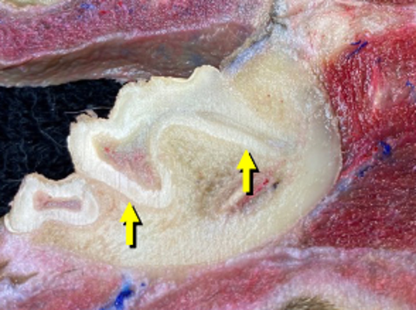 <p>Specialized fibrous joint that anchors a tooth to its alveoli in the maxilla, incisor or mandible bones</p>