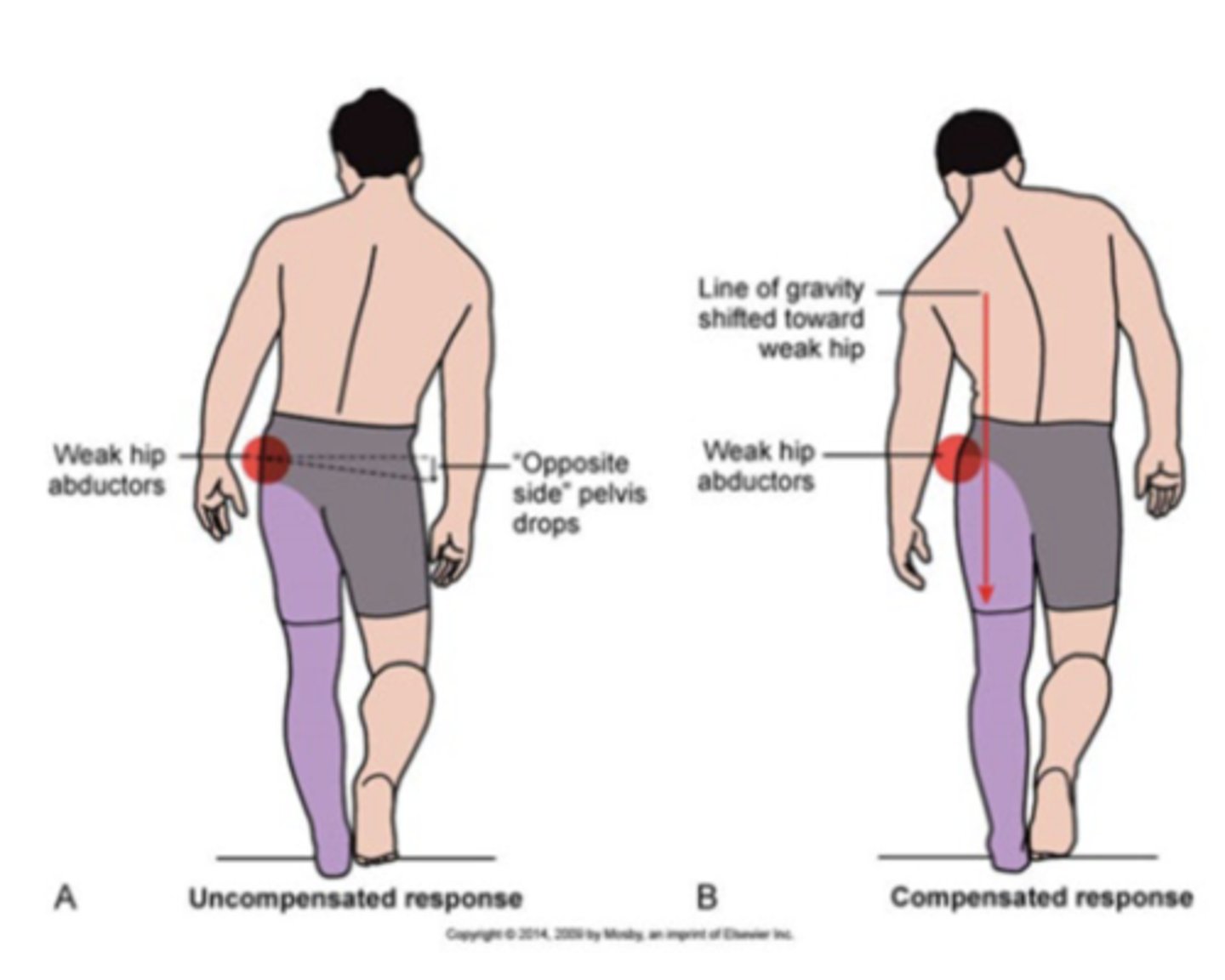 <p>gait deviations</p><p>- surgery induced</p><p>- chronic history</p>