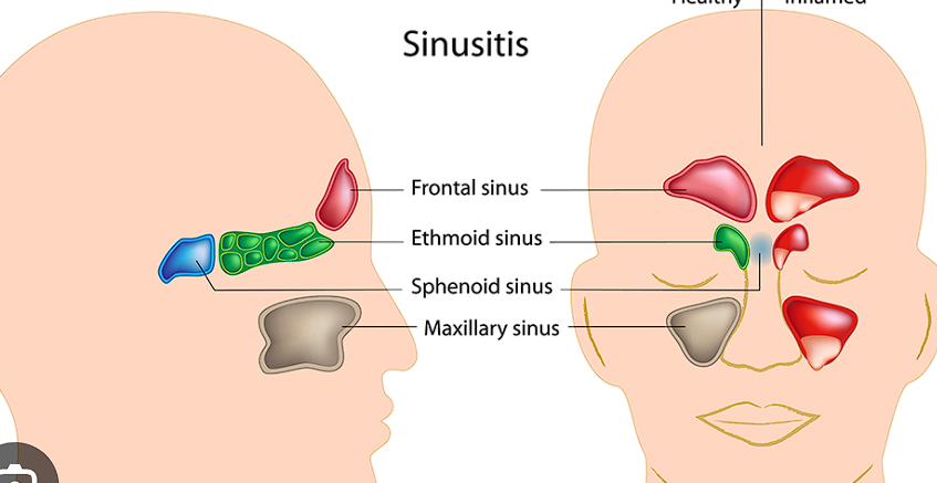 <ul><li><p>frontal</p></li><li><p>ethmoid</p></li><li><p>sphenoid</p></li><li><p>maxillary</p></li></ul><p></p>