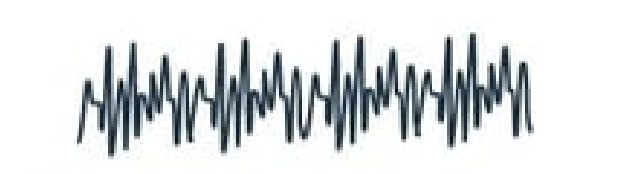 <p><strong>Q:</strong> What does gamma frequency represent in EEG?</p>