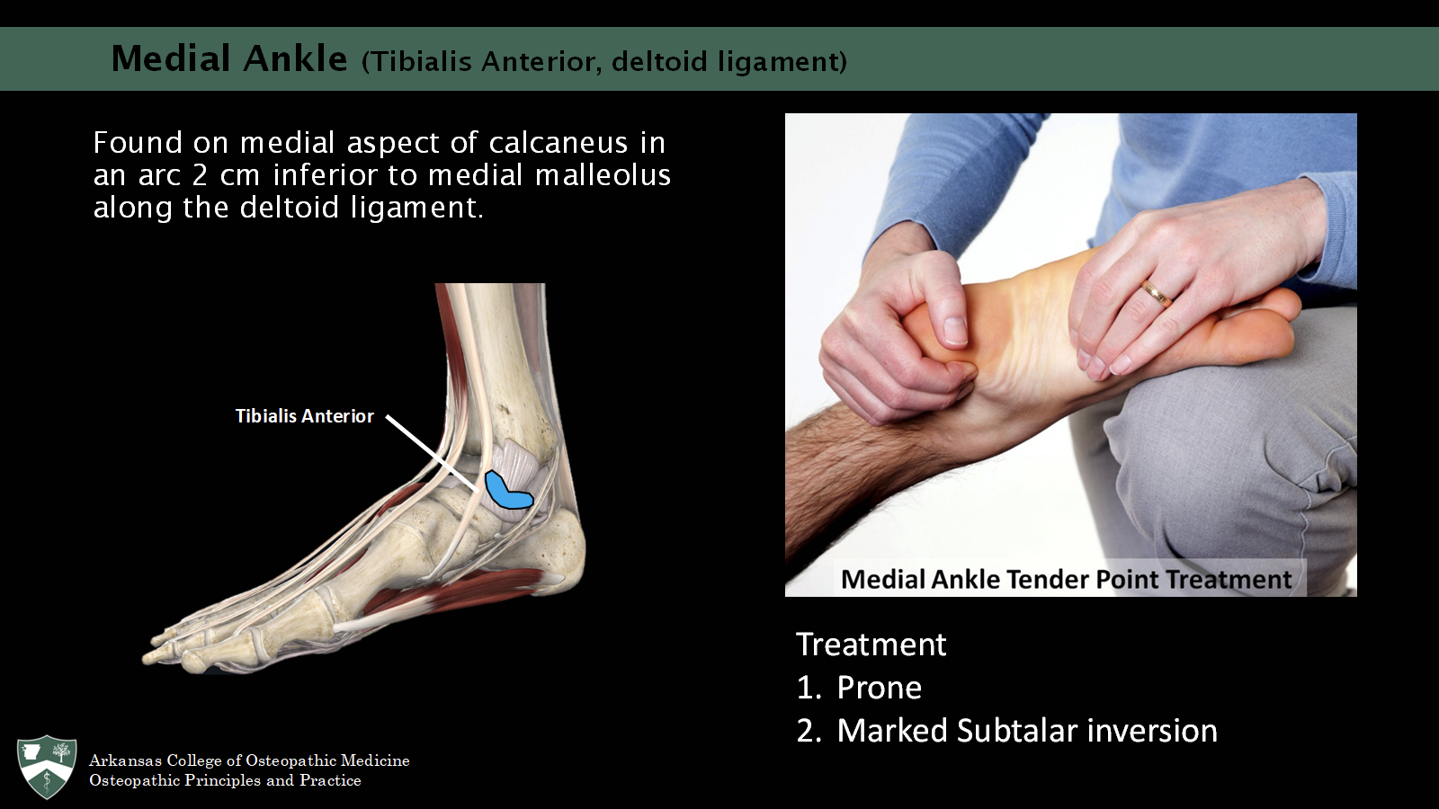 <p><span>Found on medial aspect of calcaneus in an arc 2 cm inferior to medial malleolus along the deltoid ligament.</span></p><p><span>tx: prone, marked subtalar inversion </span></p>