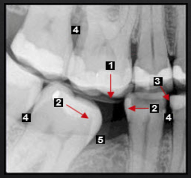 <ul><li><p>Super-eruption, resulting in root and furcation exposure</p></li><li><p>Molar tipping, creating a pseudopocket (5)</p></li><li><p>Open contact, a risk factor for food impaction and gingival inflammation (4)</p></li></ul><p></p>