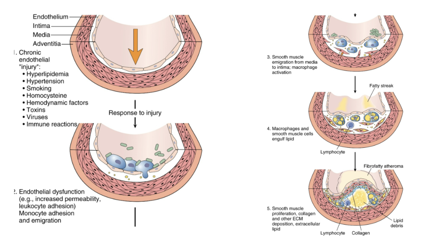 <p>fibrous cap rupture (leads to thrombus formation or embolism)</p>