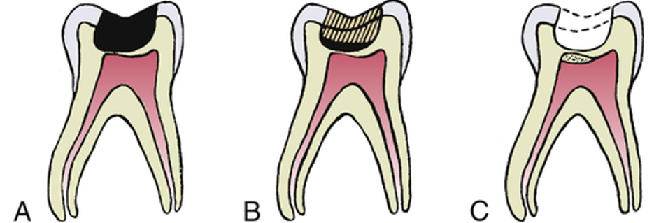 <ul><li><p>Can happen naturally from caries or from caries excavation</p></li><li><p>Can be saved or lost be necrosis</p></li><li><p>Indirect pulp therapy:</p><ul><li><p>Remove a large portion of deep caries but seal with biocompatible cement</p></li><li><p>After 6-8 weeks, reopen cavity and remove remaining caries. Sound dentin barrier protects the pulp and tooth is ready for restoration</p></li></ul></li><li><p>Direct pulp therapy:</p><ul><li><p>Accidentally perforate pulp</p></li><li><p>Place medicated restoration over exposed pulp</p></li><li><p>Requirements:</p><ul><li><p>Field needs to be sterile</p></li><li><p>Size of perforation must be minimal</p></li><li><p>No pain is felt</p></li><li><p>Clotting can occur</p></li><li><p>Calcium hydroxide or MTA stimulate “dentin bridge” formation</p></li></ul></li><li><p>More successful in young teeth because apical foramen is larger, contains more cells, more vascular, more tissue fluid, and less collateral circulation</p></li></ul></li></ul><p></p>