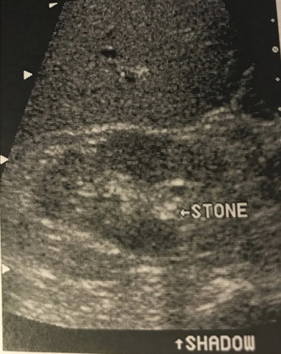 <p>Reflection</p><p>Because of the large acoustic impedance mismatch between soft tissue and calcium, most of the sound is reflected at the stone tissue interface. Very little sound is transmitted thru the stone to provide reflections from tissue distal to the stone. This results in shadowing distal to the calcification</p>
