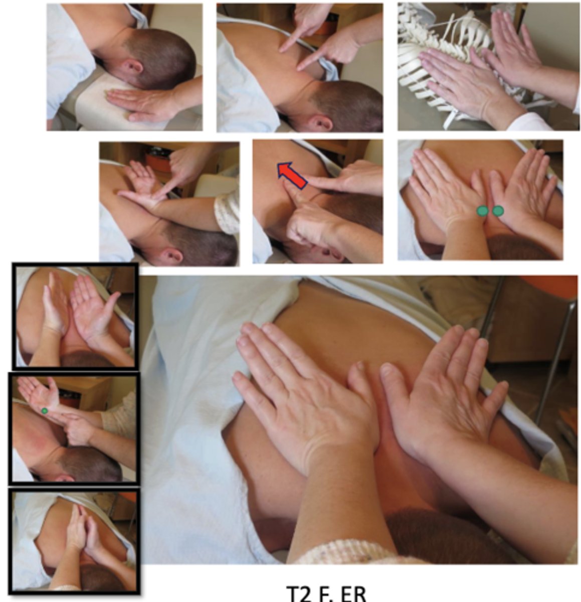 <p>• PP: Prone, headpiece in NEUTRAL to induce extension in the thoracocervical spine, permission to open gown/contact, identify segment</p><p>• DP: Standing at the head end of the table facing caudal, transferring additional body weight into contact</p><p>• CH: Bilateral thenar contacts running parallel to the spine , contacting bilateral transverse process of superior vertebrae</p><p>• IH: Same as above</p><p>• Vector: P-A and S-I</p><p>*Alternative contact: Hypothenar (pisiform)</p><p>*T1-T4</p>