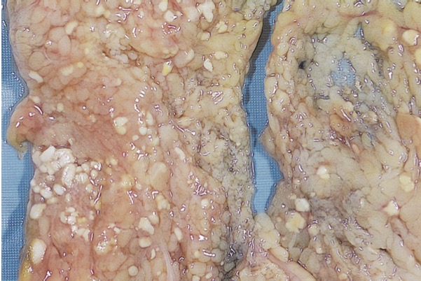 <p>Fat necrosis </p>