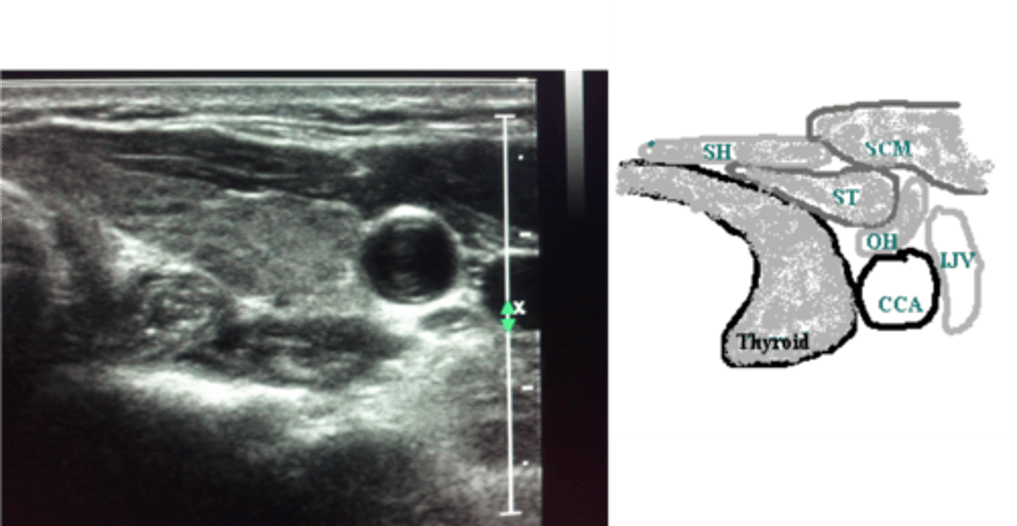 <p>Sternohyoid, sternothyroid, and omohyoid</p>