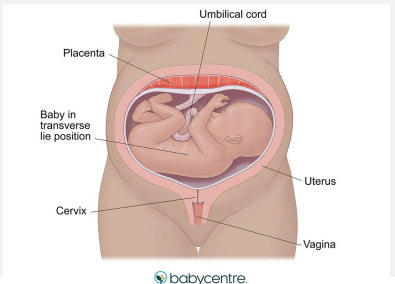 <p><strong>Transverse Presentation</strong></p><p>-Fetus lies ___________ in the pelvis, so it is _____________ to the mother </p><p>-The presenting part is usually the _________ but can be iliac crest, hand, or ______</p>