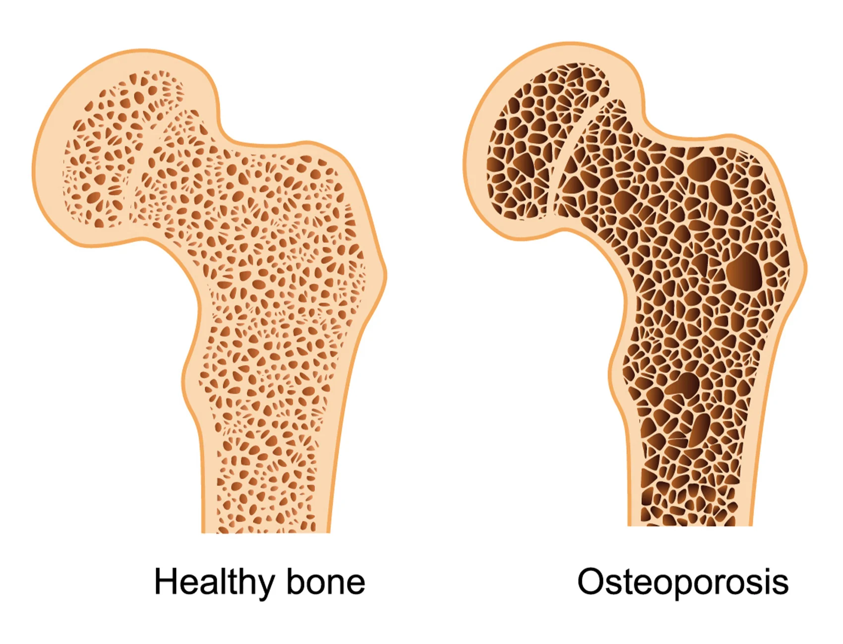 <ul><li><p>decrease in bone mass</p></li><li><p>think POROUS (like a sponge has pores which contribute to its mass)</p></li><li><p>happens to older women from decrease in ESTROGREN</p></li><li><p>osteoblasts are affected </p></li></ul><p></p>