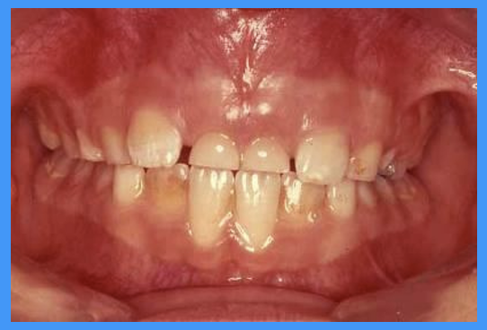 <p>what does this clinical image show</p>