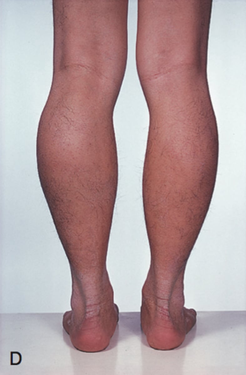 <p>Muscular dystrophy (Duchenne, due to X-linked frameshift &gt; truncated dystrophin)</p><p>Dilated cardiomyopathy (DCM)</p><p>High CK</p>