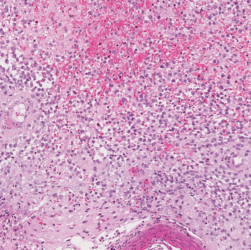 <p>Patient avec mass ORL </p><p>1) Diagnostic </p><p>2) Histologie</p><p>3) IHC </p><p>4) Moléculaire </p>