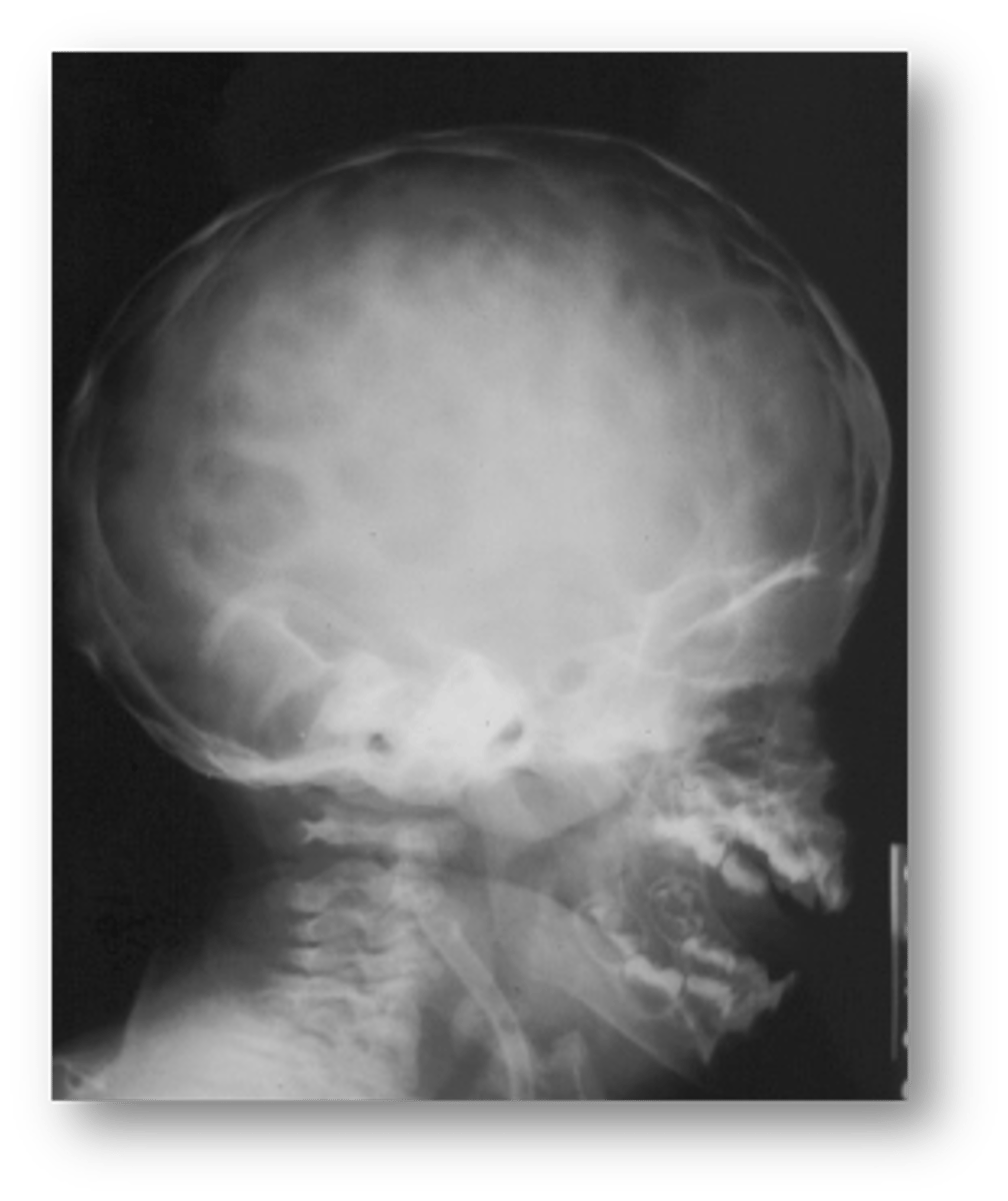 <p>Gyral/ convolutional markings on skull resembling ‘beaten metal’ is associated with:</p>
