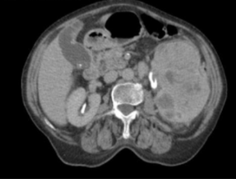 <p><span style="color: rgb(63, 135, 80)">CT Kidneys </span><span style="color: #000000">scan 4</span></p>