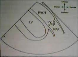 <p>What anatomy is seen in the RVOT view?</p>