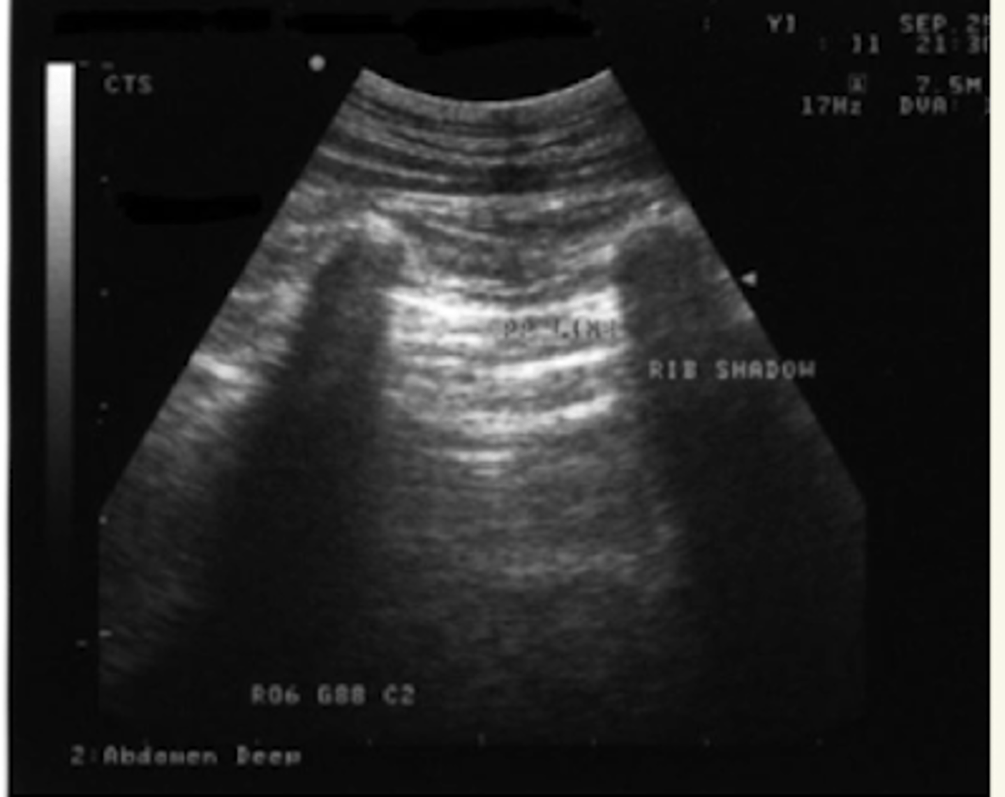 <p>SI- por las costillas</p>