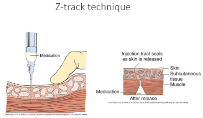 <ul><li><p><strong>Needles used</strong>: 18-21 gauge</p></li><li><p><strong>Amount of medication that can be given</strong>: 3 mL is the max</p></li><li><p><strong>Angle used</strong>: 90 degrees</p></li><li><p><strong>Special considerations:</strong></p><p><u><mark data-color="red">Technique: Z track technique - prevents med from leaking through the tissue as it can be irritating</mark></u></p><ul><li><p><mark data-color="red">PER BOOK - We insert the needle aspirate - if you see blood then do not inject, draw the needle and then go in again. (</mark><u><mark data-color="red">WHY</mark></u><mark data-color="red">? because you do not want to give the medication in the bloodstream, you want to give it intramuscularly).</mark></p></li><li><p><mark data-color="red">PER CDC - you do not aspirate for self admin, or vaccines.&nbsp;</mark></p></li></ul></li></ul>
