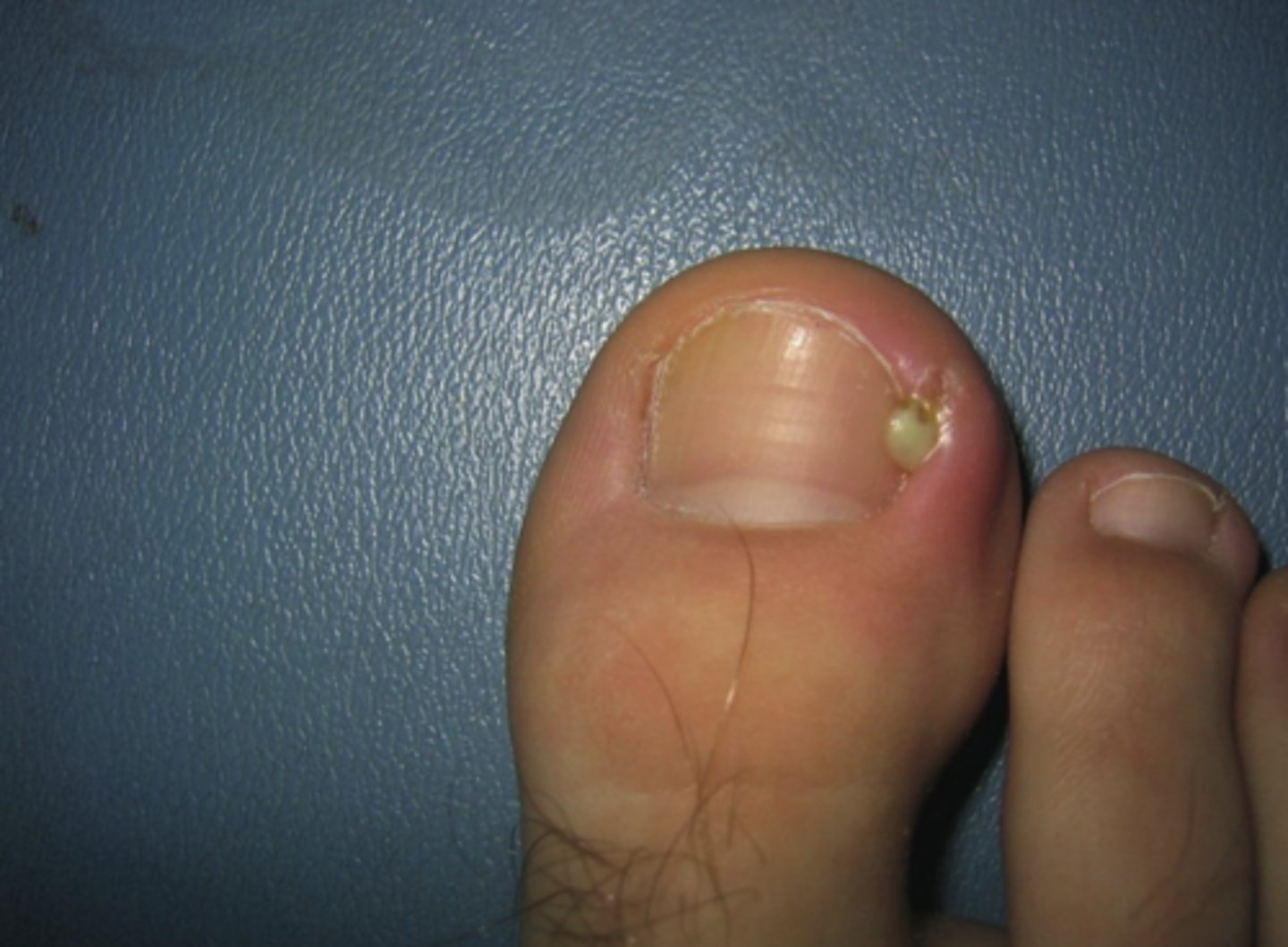 <p>Exudate that contains pus; composed of white blood cells, proteins, and tissue</p><p>I'm so sorry this picture is literally vile... but i guess it will help with the desensitization</p>