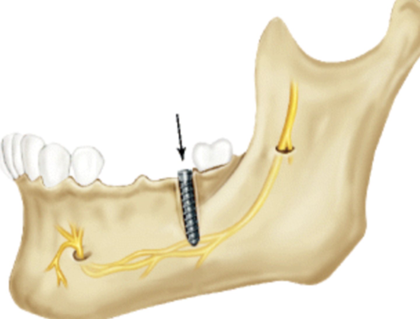 <p>(1) Treating the neurosensory disturbance</p><p>(2) Deciding how to restore the affected dental area</p>