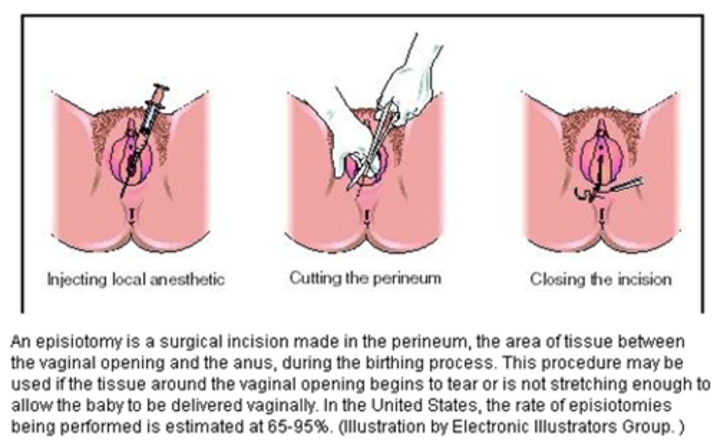 <p>surgical incision of the perineum to enlarge the vagina and so facilitate delivery during childbirth</p>