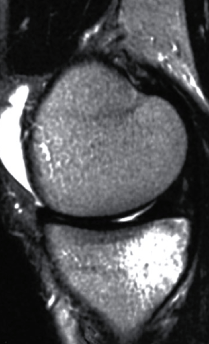 <p>what can be seen on the medial tibial plateau in this image and what type of image is this?</p><p>a. tumor, T1 MRI</p><p>b. complex fracture, CT scan</p><p>c. bone bruise, T2 MRI</p><p>d. AVN, conventional radiograph</p>