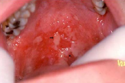 <p>What kind of antineoplastic treatment is this?</p>