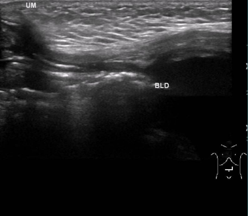 <ul><li><p>About 50% of cases</p></li><li><p>Both ends remain open, causing urine to leak from the umbilicus</p></li></ul><p></p>