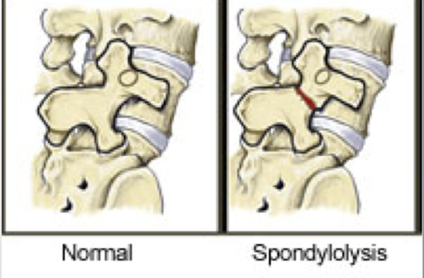 <p>Fracture of Pars Interarticularis, = spondylolysis. Could lead to spondylolisthesis. Head = TP, Body = Lamina &amp; SP, Ear = SAP, Forefoot = IAP</p>