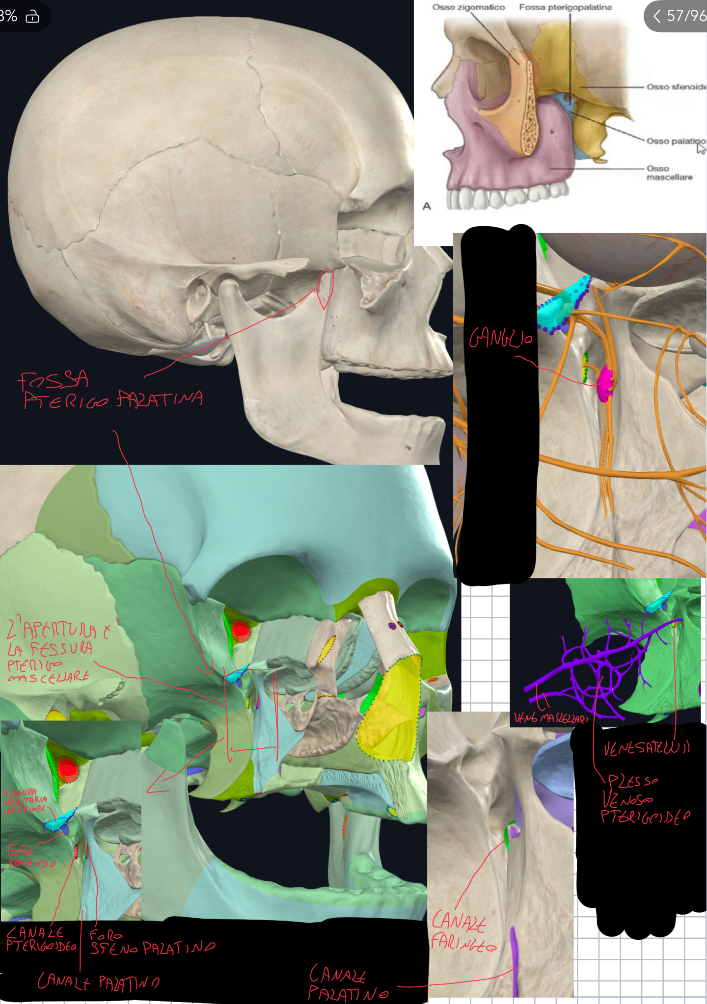 <p>Piccolo spazio profondo a forma a goccia rovesciata, centro di distribuzione di arteria e nervo mascellare.</p><p>Limiti:</p><ul><li><p>Posteriore → processo pterigoideo dello Sfenoide</p></li><li><p>Anteriore → superficie posteriore del Corpo della Mascella</p></li><li><p>Mediale → lamina perpendicolare dell’Osso Palatino</p></li><li><p>Laterale → aperta → fessura pterigomascellare (in comunicazione con la fossa infratemporale)</p></li></ul><p>Comunicazioni principali:</p><ul><li><p>Foro sfenopalatino → medialmente → per la cavità nasale (attraversato da arteria sfenopalatina e nervo nasopalatino)</p></li><li><p>Foro rotondo → posterosuperiormente → per la fossa cranica media (passa il nervo mascellare)</p></li><li><p>Canale Pterigoideo → posterosuperiormente (sotto il rotondo) → per la fossa cranica (passano fibre del nervo grande petroso superficiale e petroso profondo che formano il nervo vidiano, passa anche l’arteria del canale pterigoideo)</p></li><li><p>Canale Faringeo (palato-vaginale) → medialmente → per il rinofaringe (passano piccoli rami arteriosi e nervosi faringei) (canale delimitato da processo vaginale corpo sfenoide e osso palatino)</p></li><li><p>Fessura orbitaria inferiore → superiormente → per la cavità orbitaria (passa l’arteria infraorbitaria e nervi infraorbitaria e zigomatico)</p></li><li><p>Canale palatino → inferiormente → per la cavità orale (passa l’arteria palatina discendente e nervi palatini)&nbsp;</p></li><li><p>Fessura pterigomascellare → lateralmente → per la fossa infratemporale (passa arteria mascellare)</p></li></ul><p>Contenuto:</p><ul><li><p>Tratto Terzo (pterigopalatino) della Arteria Mascellare che con i suoi rami attraversa fori comunicando con altre cavità:</p><ul><li><p>Arteria palatina discendente → raggiunge cavità orale</p></li><li><p>Arteria Alveolare superiore posteriore → per i denti dell’arcata mascellare (superiore)</p></li><li><p>Arteria Sfenopalatina → per la cavità nasale</p></li><li><p>Arteria Faringea → per il rinofaringe</p></li><li><p>Arteria del canale pterigoideo insieme al nervo vidiano</p></li><li><p>Arteria Infraorbitaria → che passa per solco e canale infraorbitario per poi ramificare in alveolare superiore (anteriore, media, anche essi per arcata superiore) e infine terminare sulla faccia del viscerocranio attraversando il foro infraorbitario</p></li></ul></li></ul><ul><li><p>Vene Satelliti → drenano nel Plesso Venoso Pterigoideo → da cui emergono le Vene Mascellari</p></li></ul><ul><li><p>Nervo Mascellare (V2)</p><ul><li><p>Dalla cavità cranica media, attraverso il Foro Rotondo entra nella Fossa Pterigopalatina (porta fibre sensitive) → da qui partiranno rami alveolari, zigomatici, infraorbitari ecc…</p></li></ul></li></ul><ul><li><p>Ganglio Pterigopalatino (stazione parasimpatica, situato vicino il foro sfenopalatino)</p><ul><li><p>Riceve fibre dal Nervo Grande Petroso Superficiale e Nervo Petroso Profondo che insieme formano il Nervo del Canale Pterigoideo (o Nervo Vidiano) che attraversano appunto il Canale Pterigoideo&nbsp;</p></li><li><p>Le fibre del Nervo Grande Petroso Superficiale (che deriva dal nervo faciale, VII) sono parasimpatiche pregangliari → cioè dentro il ganglio formano sinapsi con fibre postgangliari parasimpatiche che partono dal Ganglio per innervare ghiandole lacrimali, nasali, palatine, faringee</p></li><li><p>Le fibre del Nervo Petroso Profondo (che deriva dal plesso carotideo) sono simpatiche postgangliari → cioè non fanno sinapsi ma attraversano comunque il Ganglio (non fanno sinapsi siccome le hanno già fatte nel ganglio cervicale superiore) → quindi escono con gli stessi rami efferenti</p></li><li><p>Riceve anche fibre sensitive che arrivano dal Nervo Mascellare, anche esse attraversano il ganglio senza modificarsi, per portare sensibilità alla mucosa di naso, palato e rinofaringe.</p></li><li><p>Tutte queste fibre che sono entrate, escono insieme come fibre miste (sensitive + vegetative) attraverso Rami Orbitali, Nasali, Palatini e Faringei, per innervare le corrispettive zone.</p></li></ul></li></ul><p></p><p></p>