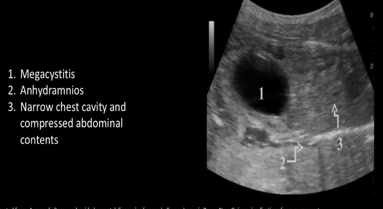 <p><strong>nonvisualization</strong> of fetal <strong>abd muscles, urinary tract abn, </strong>and <strong>undescended testes</strong> are classic triad of signs of ___ syndrome</p><p>a) prune belly</p><p>b) turner</p><p>c) meckel gruber</p><p>d) cornelia de lange</p>