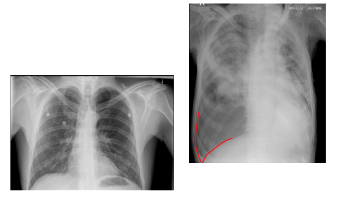 <ul><li><p>lack of lung marking</p></li><li><p><strong>deep sulcus sign</strong></p></li><li><p>sharply outlined diaphragm</p></li></ul><p></p>