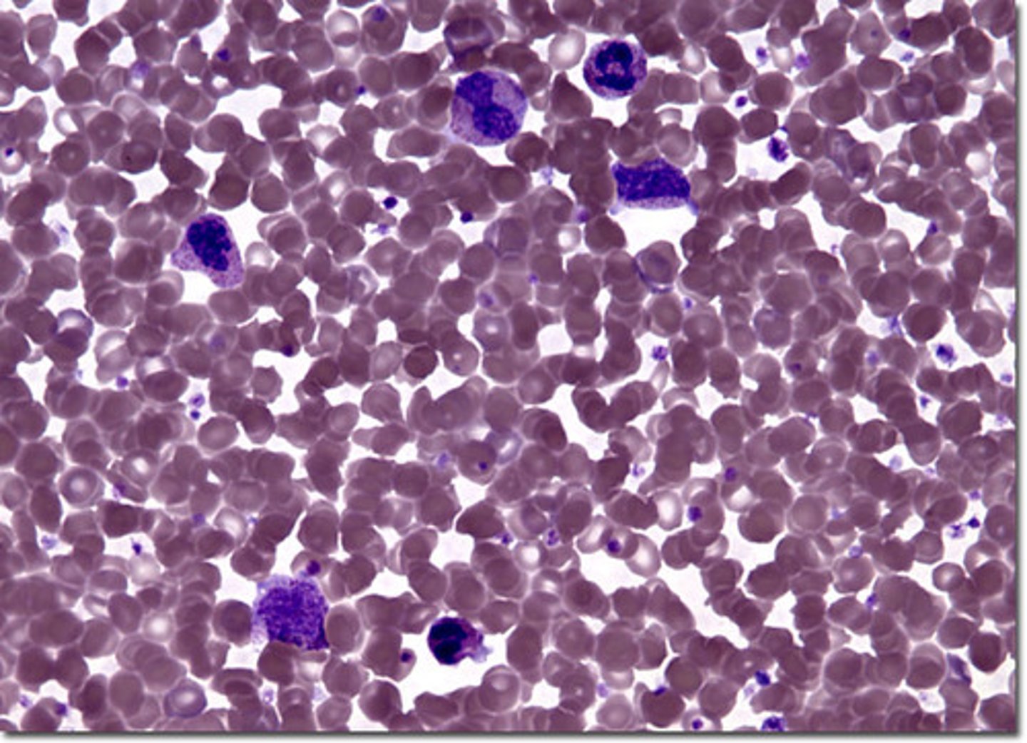 <p>polycythemia (erythrocytosis)</p>