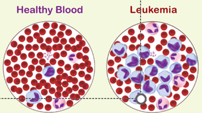 <ul><li><p>cancer resulting in over-production of abnormal leukocytes</p></li><li><p>“Extra cells originate from single abnormal cell</p></li><li><p>Abnormal leukocytes remain unspecialized, proliferate extensively</p><ul><li><p>Cancerous leukocytes crowd red marrow &amp; immature leukocytes flood bloodstream</p><ul><li><p>Other blood cell types are crowded out of blood, resulting in anemia &amp; bleeding problems</p></li></ul></li></ul></li><li><p>Do not defend the body as they shouldinfection &amp; hemorrhage occurs</p><p></p></li></ul><p></p>