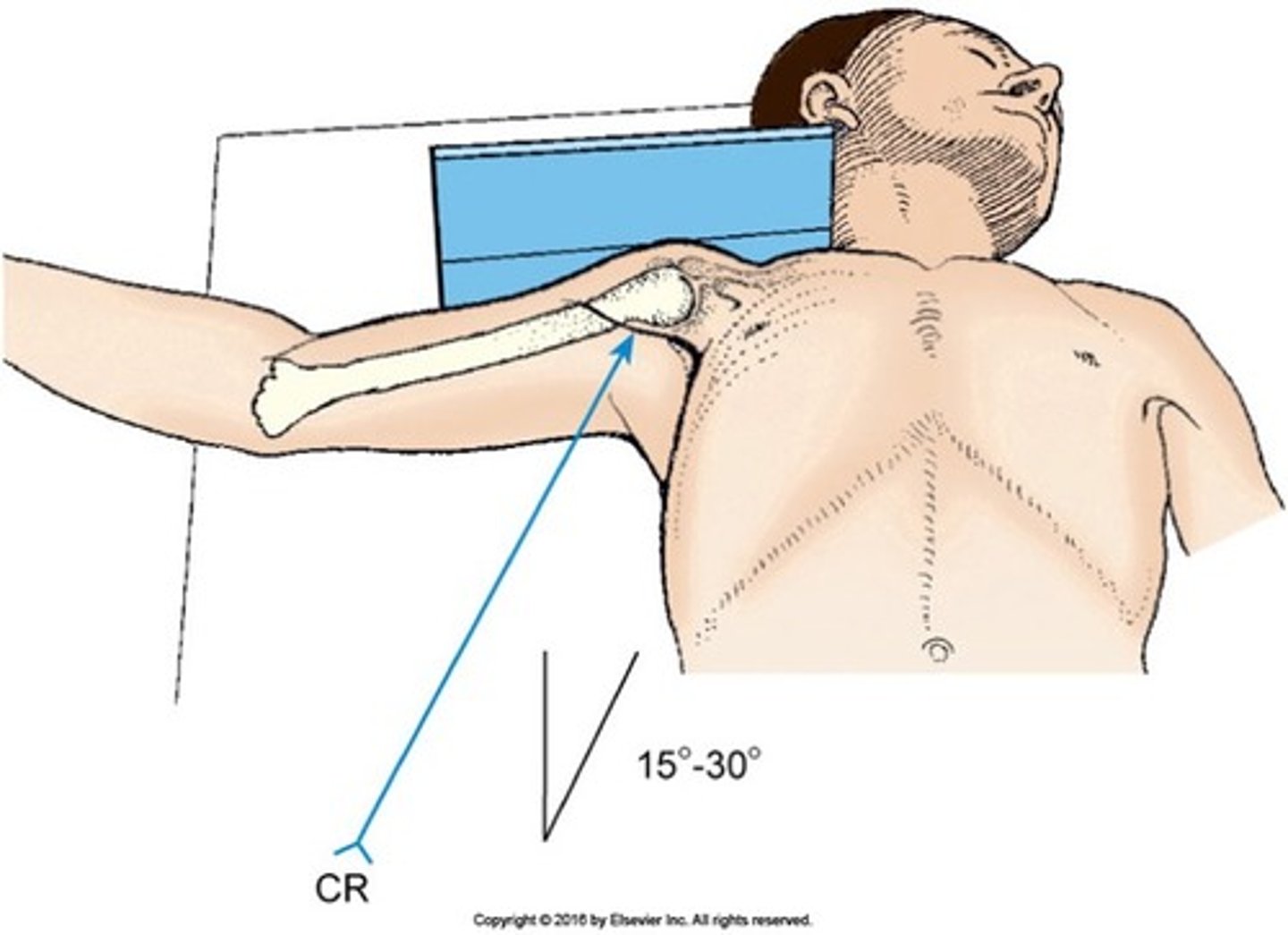 <p>- supine</p><p>- head and shoulders elevated on a 3" radiolucent sponge</p><p>- head turned away from CR</p><p>-abduct arm to right angle and place arm in a lateral rotation</p>