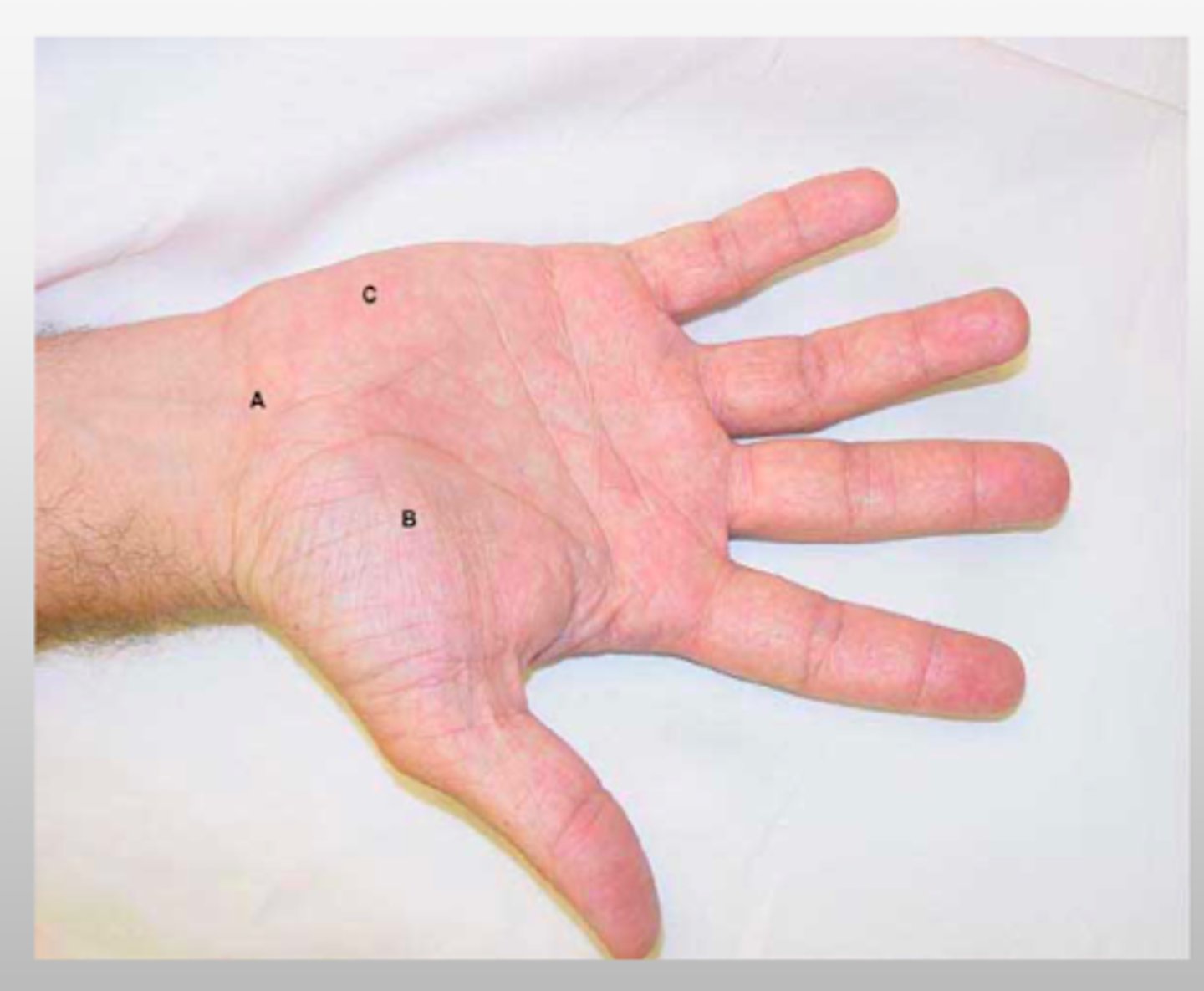 <p>A → distal wrist crease</p><p>B → thenar eminence</p><p>C → hypothenar eminence</p>
