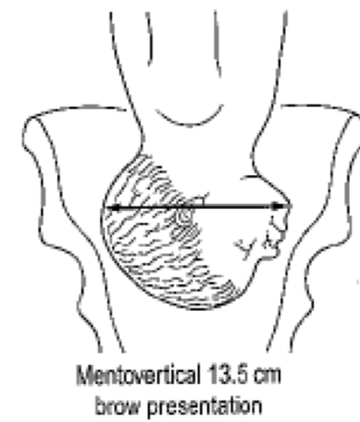 <ul><li><p>partially extended head</p></li><li><p>MV diameter 13.5cm</p></li><li><p>Bi temporal diameter 8.2cm</p></li><li><p>Vaginal delivery extremely unlikely as MV diameter too long </p></li></ul><p></p>