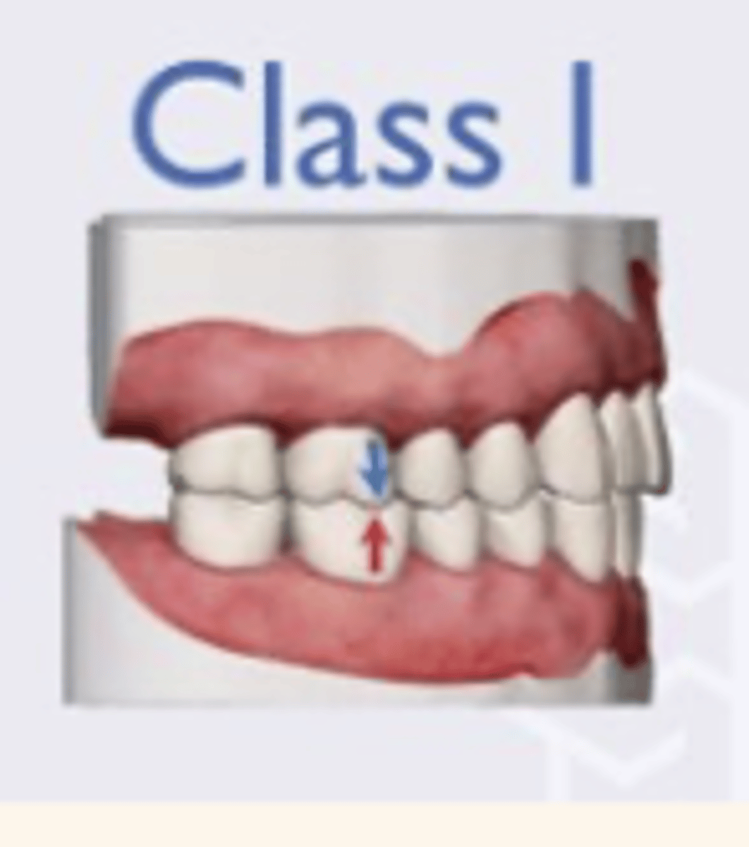 <p>MB cusp of maxillary 1st molar occludes with the buccal groove of the mandibular 1st molar</p>