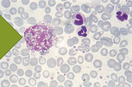 <ul><li><p>leukocytes that have ruptured</p></li><li><p>not significant unless in large numbers</p><ul><li><p>associated with leukemia</p></li></ul></li><li><p>artifact when making blood smear</p></li></ul><p></p>