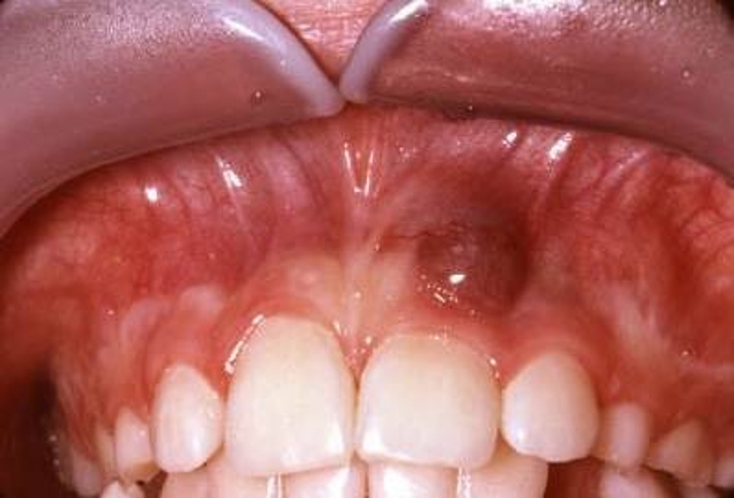 <p>An oral pathologic condition that appears in the mouth as an overgrowth of tissue due to irritation or trauma. It presents as a lobular, purplish-blue exophytic nodule exclusively on the gingiva, both edentulous and dentate, and usually anterior to the molars. It originates from the periodontal ligament or the periosteum. It occurs across a wide age range, commonly in children, young adults, and in females. It presents as sessile or pedunculated and smooth surfaced or lobular, and though usually painless it can occasionally be ulcerated, painful and accompanied by bleeding. Like pyogenic granuloma, it is usually present either on the buccal or lingual gingiva or between teeth, but it can occasionally surround the teeth and act aggressively by displacing teeth much like a sarcoma. It appears only on the gingiva or on an edentulous (without teeth) alveolar ridge. It is more often found in the mandible rather than the maxilla but can be found in either anterior or posterior areas. The underlying alveolar bone can be destroyed, leaving a unique appearance referred to as "cupping resorption" or "saucerization."</p>