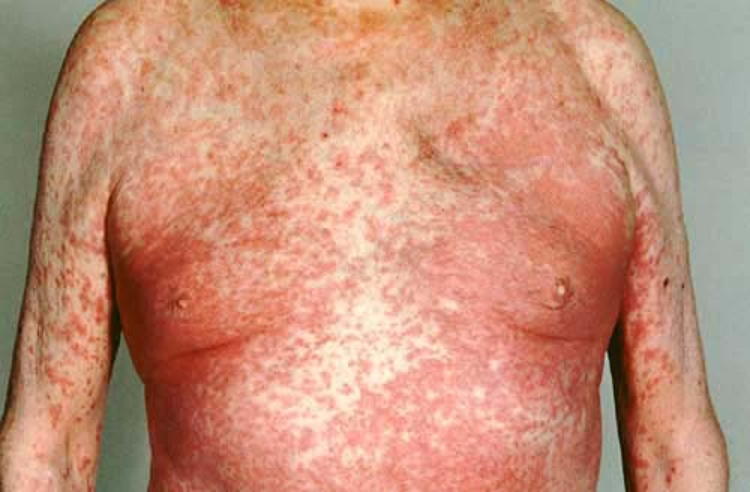 <p>Cutaneous Drug Reaction </p>