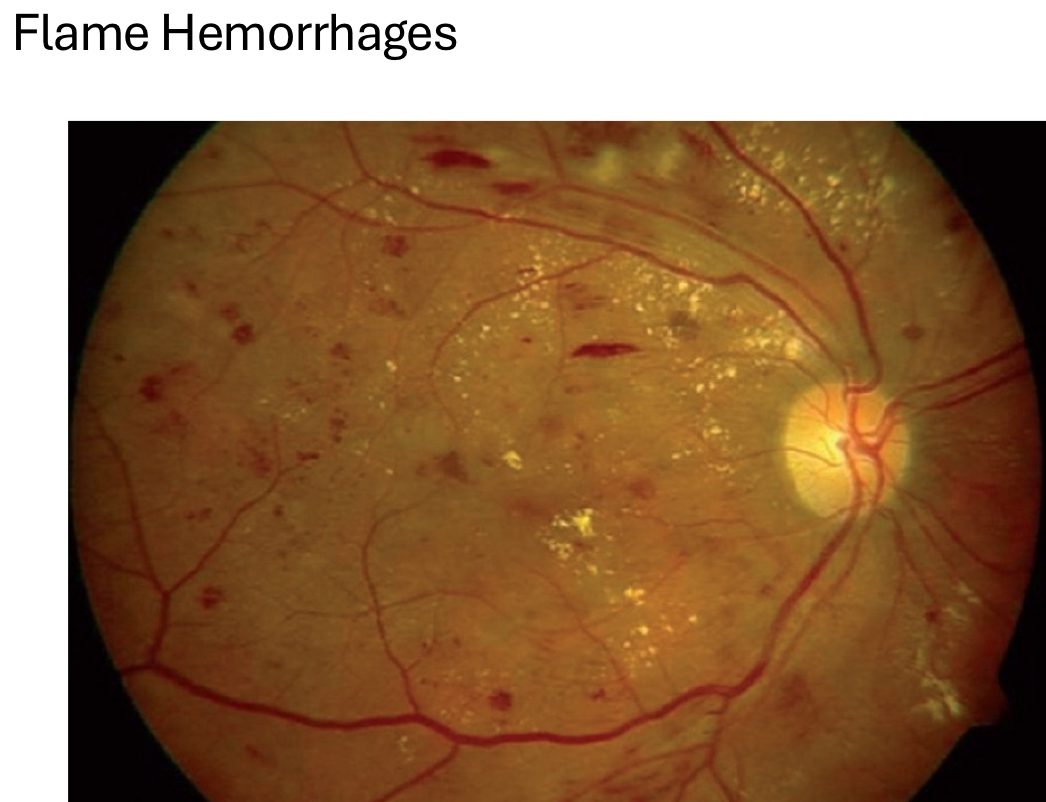 <p>flame hemorrhages</p>