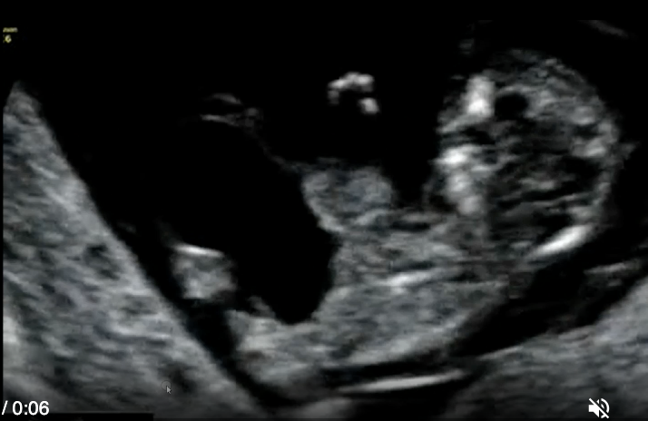 <p>this is a routine 1st trimester scan. this shows</p><p>a) omphalocele + ectopia cordis</p><p>b) cloacal extrophy</p><p>c) normal midgut herniation</p><p>d) vanishing twin syndrome </p>