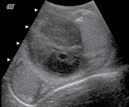 <p>sono findings assoc with scrotal rupture</p>