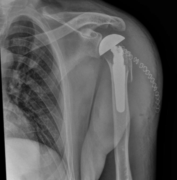 <p>Indications for Hemiarthroplasty </p>
